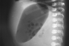 gastroparesia-1999-002