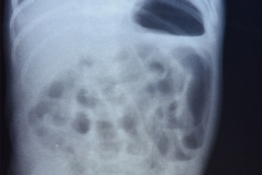 gastroparesia-o-gastroplejia-niveles-gastricos-002
