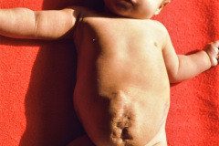 gastrosquisis-cicatrices-postop-6m-1992-001