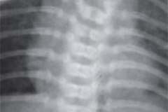 goldenhar-alteraciones-vertebrales-cervical-toracica-lumbar-hemivertebras-raquisquisis-1989-000