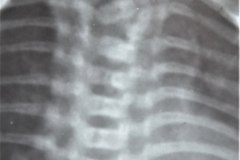 goldenhar-alteraciones-vertebrales-cervical-toracica-lumbar-hemivertebras-raquisquisis-1989-001