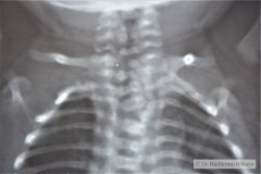 goldenhar-alteraciones-vertebrales-cervical-toracica-lumbar-hemivertebras-raquisquisis-1989-003