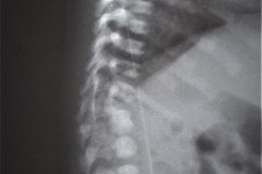 goldenhar-alteraciones-vertebrales-cervical-toracica-lumbar-hemivertebras-raquisquisis-1989-004