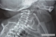 goldenhar-alteraciones-vertebrales-cervical-toracica-lumbar-hemivertebras-raquisquisis-1989-005