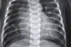 goldenhar-costilla-supernumeraria-cardiomegalia-1985-000