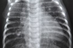 goldenhar-costilla-supernumeraria-cardiomegalia-1985-001