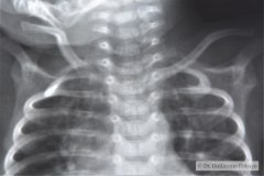 goldenhar-costilla-supernumeraria-cardiomegalia-1985-002