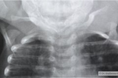 goldenhar-costilla-supernumeraria-cardiomegalia-1985-003