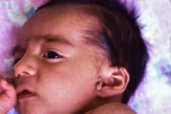 goldenhar-dermoide-conjuntiva-1994-000
