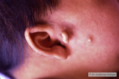 goldenhar-dermoide-conjuntiva-1994-001