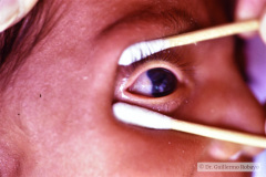 goldenhar-dermoide-conjuntiva-1994-002