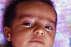 goldenhar-dermoide-conjuntiva-1994-005