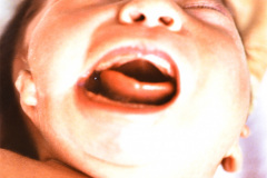 goldenhar-dermoide-conjuntiva-anotia-1989-002