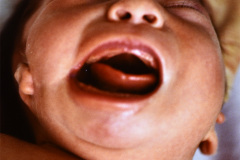 goldenhar-dermoide-conjuntiva-anotia-1989-003