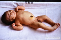 goldenhar-dermoide-conjuntiva-anotia-1989-004