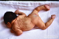 goldenhar-dermoide-conjuntiva-anotia-1989-005