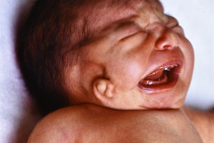 goldenhar-dermoide-conjuntiva-anotia-1989-006