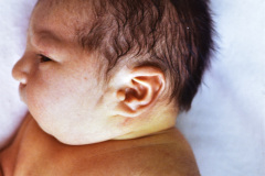 goldenhar-dermoide-conjuntiva-anotia-1989-008
