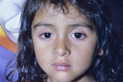 goldenhar-dermoide-conjuntival-anotia-fistula-preauricular-der-001