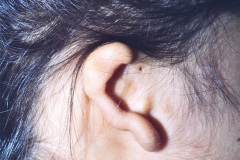 goldenhar-dermoide-conjuntival-anotia-fistula-preauricular-der-005