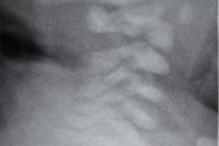 goldenhar-fusion-vertebral-cervical-1997-000