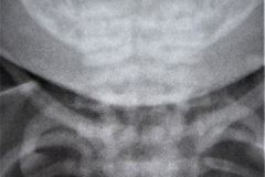 goldenhar-fusion-vertebral-cervical-1997-001