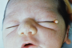 granuloma-escamoso-pediculado-conjuntiva-izq-001
