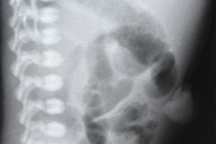 grasa-preperitoneal-1991-000