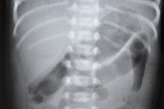 grasa-preperitoneal-1991-002