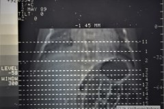 hemangioendotelioma-hepatico-tac-1989-000