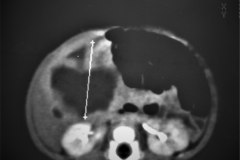 hemangioendotelioma-hepatico-tac-1989-010