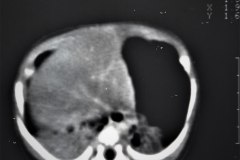 hemangioendotelioma-hepatico-tac-1989-012