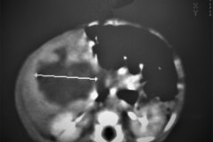 hemangioendotelioma-hepatico-tac-1989-014