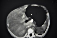 hemangioendotelioma-hepatico-tac-1989-017