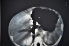 hemangioendotelioma-hepatico-tac-1989-019