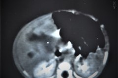 hemangioendotelioma-hepatico-tac-1989-022