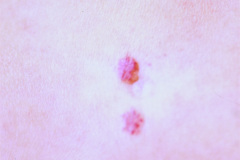 hemangioma-capilar-simple-sacro-6m-1989-000
