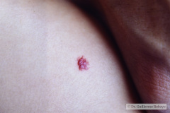 hemangioma-capilar-superficial-o-fresa-000