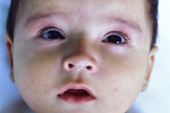 hemangioma-cavernoso-brazo-001