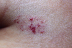 hemangioma-cavernoso-brazo-002