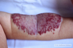 hemangioma-cavernoso-brazo-003