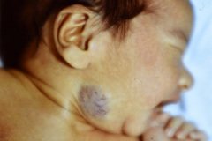 hemangioma-cavernoso-cara-002