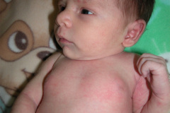 hemangioma-cavernosos-brazo-izq-2009-000