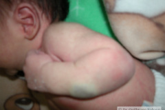 hemangioma-cavernosos-brazo-izq-2009-001