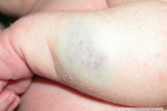 hemangioma-cavernosos-brazo-izq-2009-002