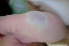 hemangioma-cavernosos-brazo-izq-2009-003