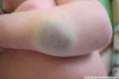 hemangioma-cavernosos-brazo-izq-2009-004