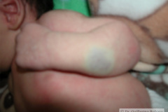 hemangioma-cavernosos-brazo-izq-2009-005