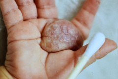 hemangioma-palma-mano-der-1988-002