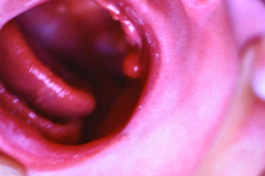 hemangioma-pediculado-encia-sup-1986-000